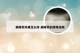 癣痒灵效果怎么样 癣痒灵的使用说明