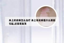 身上的皮癣怎么治疗 身上有皮癣是什么原因引起,还容易复发