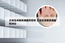 兰州五州银屑病医院官网 兰州五洲银屑病医院评价