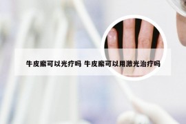 牛皮廨可以光疗吗 牛皮廨可以用激光治疗吗