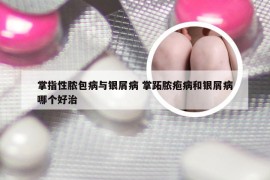 掌指性脓包病与银屑病 掌跖脓疱病和银屑病哪个好治