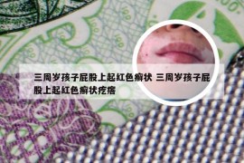 三周岁孩子屁股上起红色癣状 三周岁孩子屁股上起红色癣状疙瘩