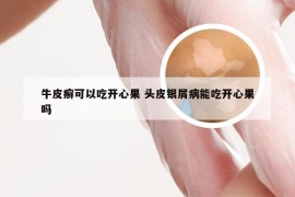 牛皮癣可以吃开心果 头皮银屑病能吃开心果吗