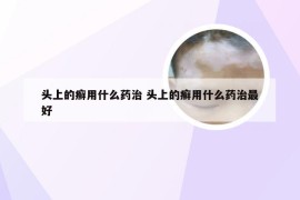 头上的癣用什么药治 头上的癣用什么药治最好