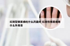 红斑型银屑病吃什么药最好 红斑性银屑病用什么外用膏