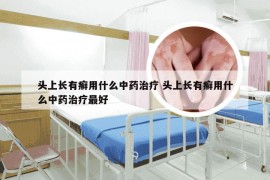 头上长有癣用什么中药治疗 头上长有癣用什么中药治疗最好