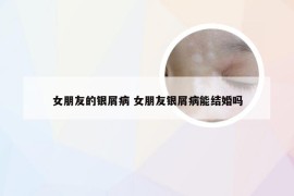 女朋友的银屑病 女朋友银屑病能结婚吗