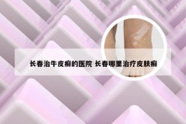 长春治牛皮癣的医院 长春哪里治疗皮肤癣