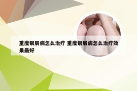 重度银屑病怎么治疗 重度银屑病怎么治疗效果最好