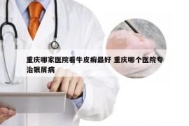 重庆哪家医院看牛皮癣最好 重庆哪个医院专治银屑病