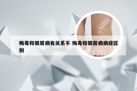 梅毒和银屑病有关系不 梅毒和银屑病病症区别