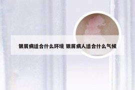 银屑病适合什么环境 银屑病人适合什么气候