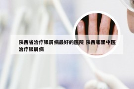 陕西省治疗银屑病最好的医院 陕西哪里中医治疗银屑病