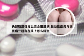 头部脂溢性皮炎混合银屑病 脂溢性皮炎与银屑病一起存在头上怎么样治