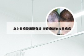 身上长癣能用斯奇康 斯奇康能治皮肤病吗