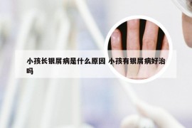 小孩长银屑病是什么原因 小孩有银屑病好治吗