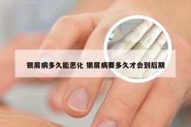 银屑病多久能恶化 银屑病要多久才会到后期