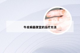 牛皮癣最便宜的治疗方法