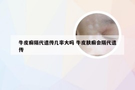 牛皮癣隔代遗传几率大吗 牛皮肤癣会隔代遗传