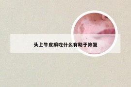 头上牛皮癣吃什么有助于恢复