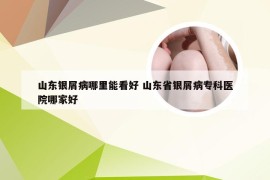 山东银屑病哪里能看好 山东省银屑病专科医院哪家好