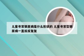 儿童寻常银屑病是什么形状的 儿童寻常型银屑病一直反反复复