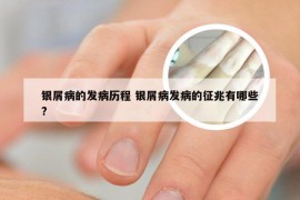 银屑病的发病历程 银屑病发病的征兆有哪些?