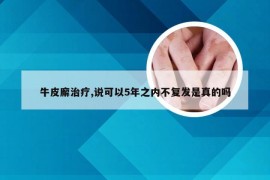 牛皮廨治疗,说可以5年之内不复发是真的吗