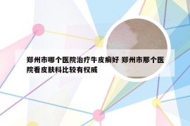 郑州市哪个医院治疗牛皮癣好 郑州市那个医院看皮肤科比较有权威