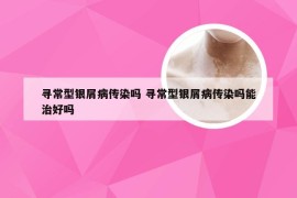 寻常型银屑病传染吗 寻常型银屑病传染吗能治好吗