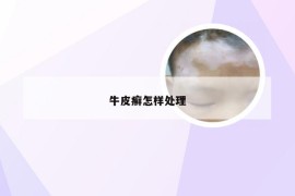 牛皮癣怎样处理