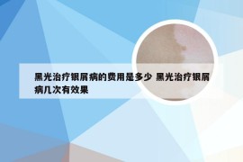 黑光治疗银屑病的费用是多少 黑光治疗银屑病几次有效果