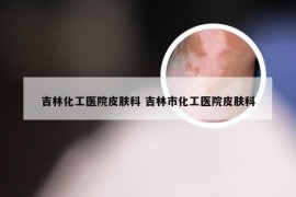 吉林化工医院皮肤科 吉林市化工医院皮肤科