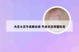 大王小王牛皮癣女孩 牛皮大王抑菌乳膏