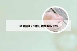 银屑病IL23降低 银屑病acr20