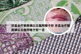 许昌治疗银屑病公立医院哪个好 许昌治疗银屑病公立医院哪个好一点