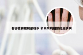 有哪些和银屑病相似 和银屑病相似的皮肤病