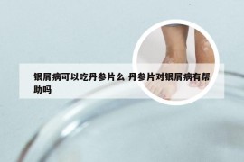 银屑病可以吃丹参片么 丹参片对银屑病有帮助吗