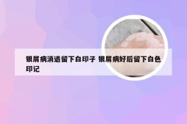 银屑病消退留下白印子 银屑病好后留下白色印记