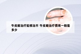 牛皮廨治疗能根治不 牛皮廨治疗费用一般是多少