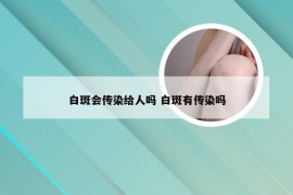 白斑会传染给人吗 白斑有传染吗