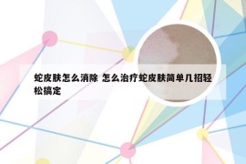 蛇皮肤怎么消除 怎么治疗蛇皮肤简单几招轻松搞定