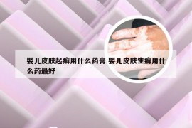 婴儿皮肤起癣用什么药膏 婴儿皮肤生癣用什么药最好