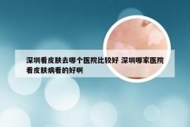 深圳看皮肤去哪个医院比较好 深圳哪家医院看皮肤病看的好啊