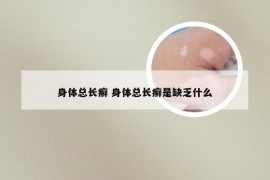 身体总长癣 身体总长癣是缺乏什么