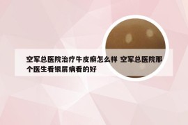 空军总医院治疗牛皮癣怎么样 空军总医院那个医生看银屑病看的好