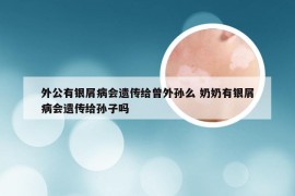 外公有银屑病会遗传给曾外孙么 奶奶有银屑病会遗传给孙子吗