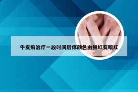 牛皮癣治疗一段时间后痒颜色由鲜红变暗红