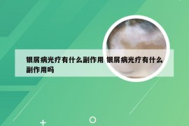 银屑病光疗有什么副作用 银屑病光疗有什么副作用吗