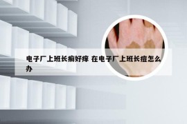 电子厂上班长癣好痒 在电子厂上班长痘怎么办